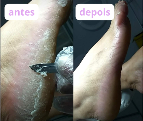 Resultado de desbaste de calos