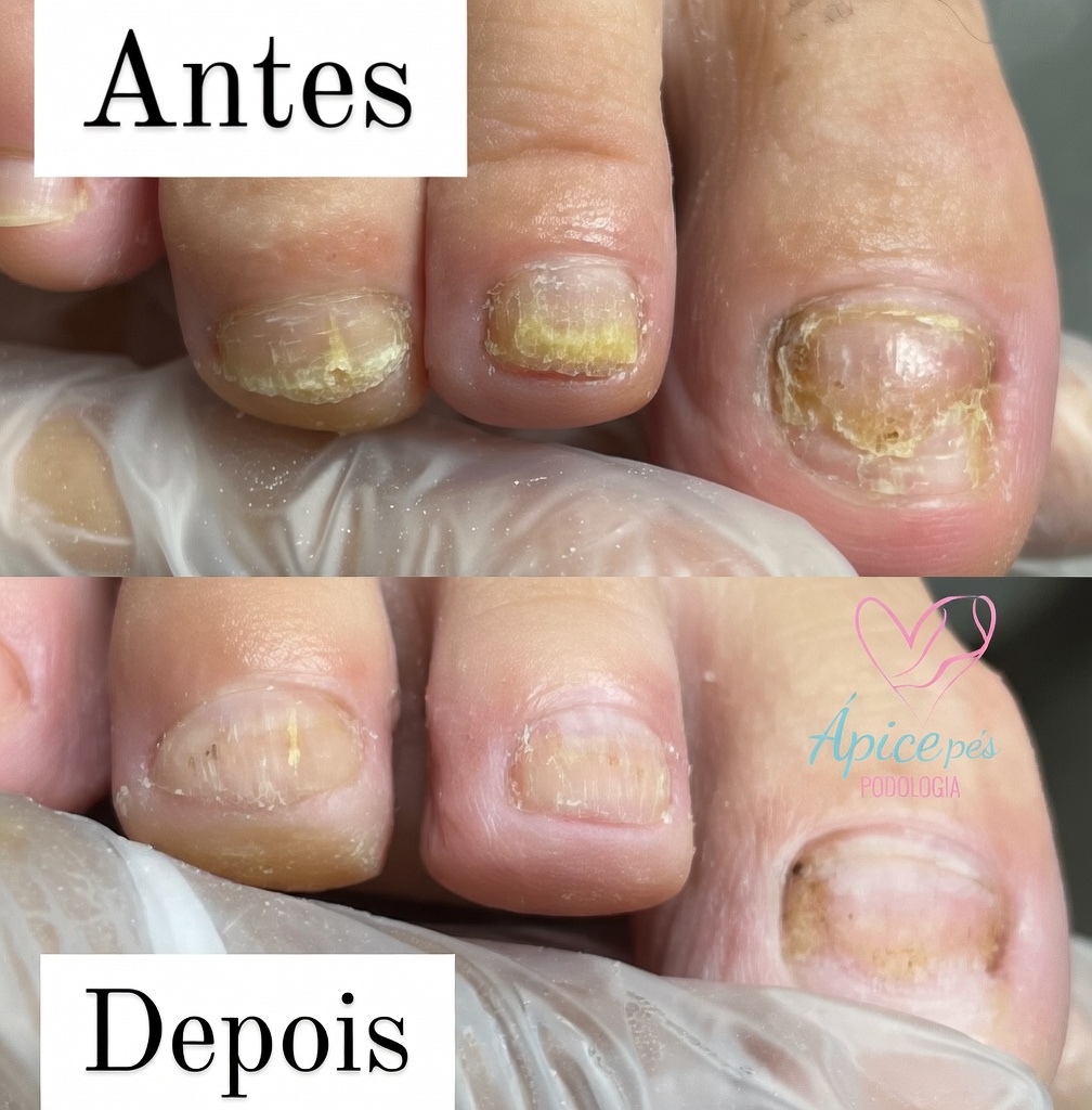 Antes e depois de unha ressecada