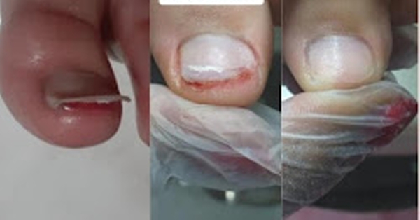 Evolução do tratamento de unha inflamada