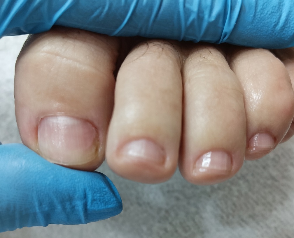 Resultado de podologia preventiva