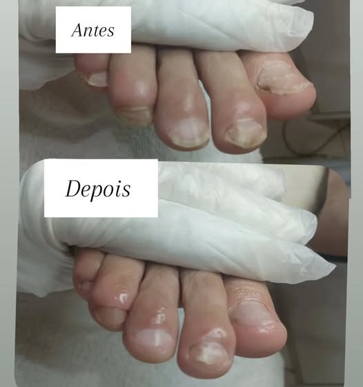 Podologia de unhas antes e depois